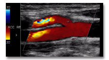 Duplex-Sonographie hirnversorgende Gef��e