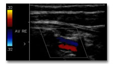 Duplex-Sonographie hirnversorgende Gef��e